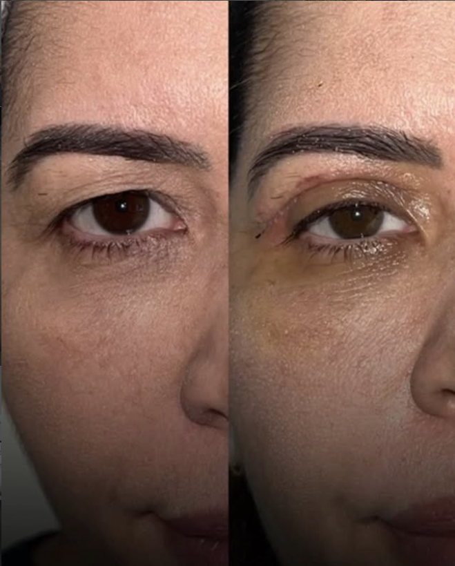Antes e depois de blefaroplastia superior — vista frontal