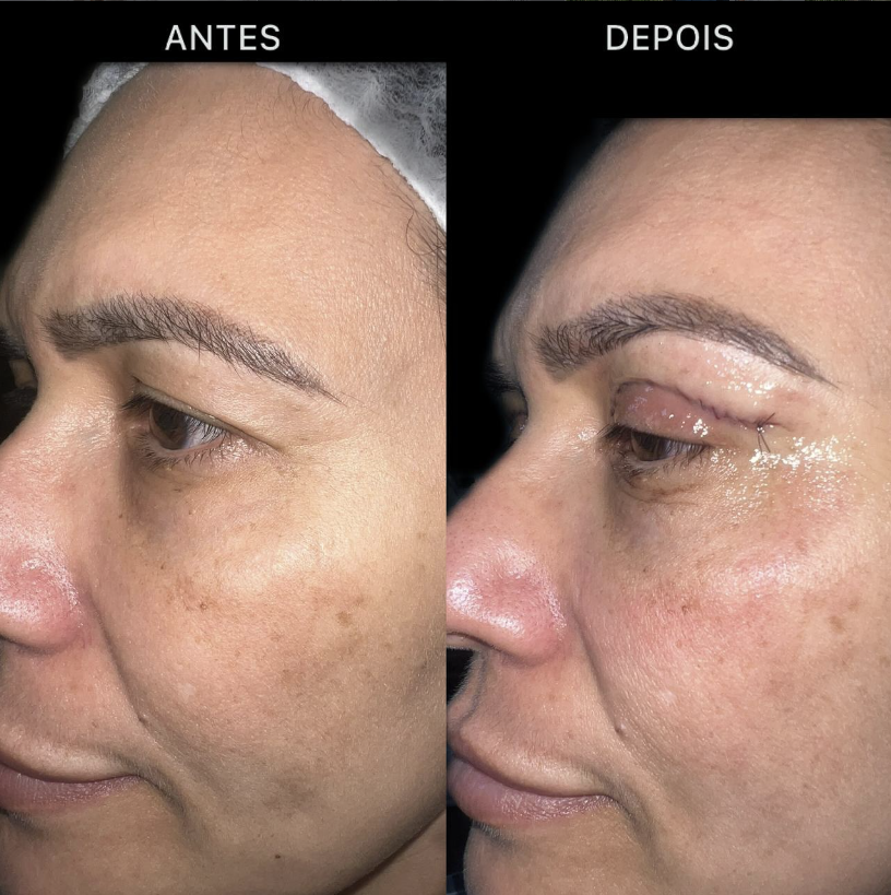 Antes e depois de blefaroplastia superior — vista lateral